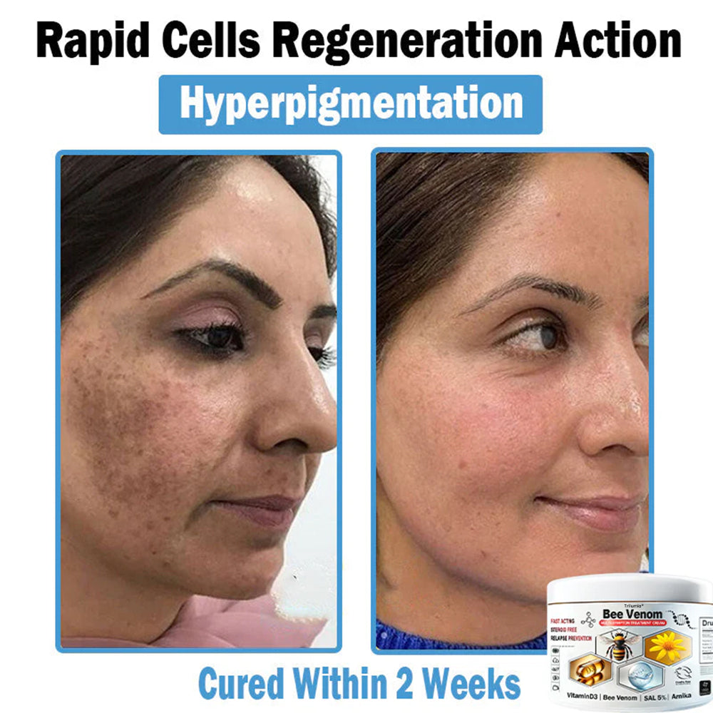 Trilumia® Bee Venom Multi-Symptom Skin Treatment Cream (👨‍⚕BAD RECOMMENDS)🌟⏰50% Off for a Limited Time – Sponsored by Boots