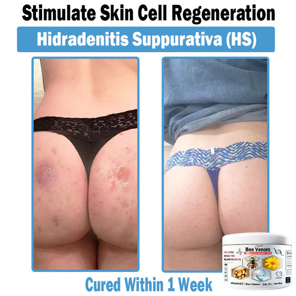 Trilumia® Bee Venom Multi-Symptom Skin Treatment Cream (👨‍⚕BAD RECOMMENDS)🌟⏰50% Off for a Limited Time – Sponsored by Boots