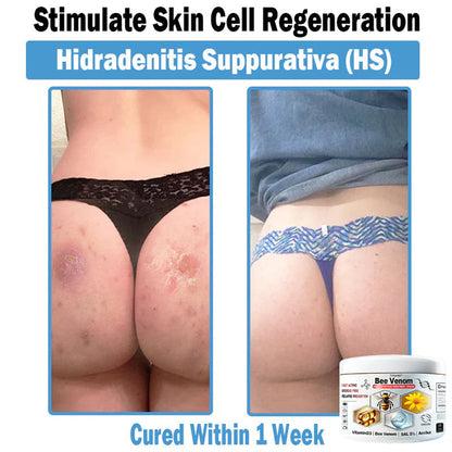 Trilumia® Bee Venom Multi-Symptom Skin Treatment Cream (👨‍⚕BAD RECOMMENDS)🌟⏰50% Off for a Limited Time – Sponsored by Boots