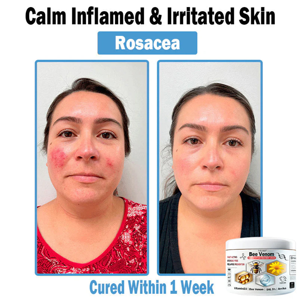 Trilumia® Bee Venom Multi-Symptom Skin Treatment Cream (👨‍⚕BAD RECOMMENDS)🌟⏰50% Off for a Limited Time – Sponsored by Boots