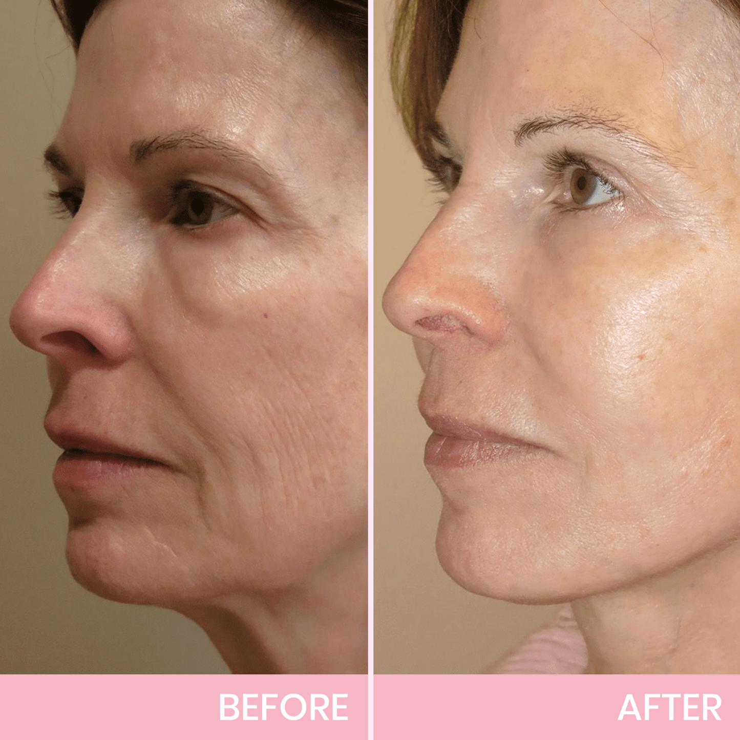MOONDAR®❤V-Face Lifting Invisible Adhesive 01 Tape 10⚕️