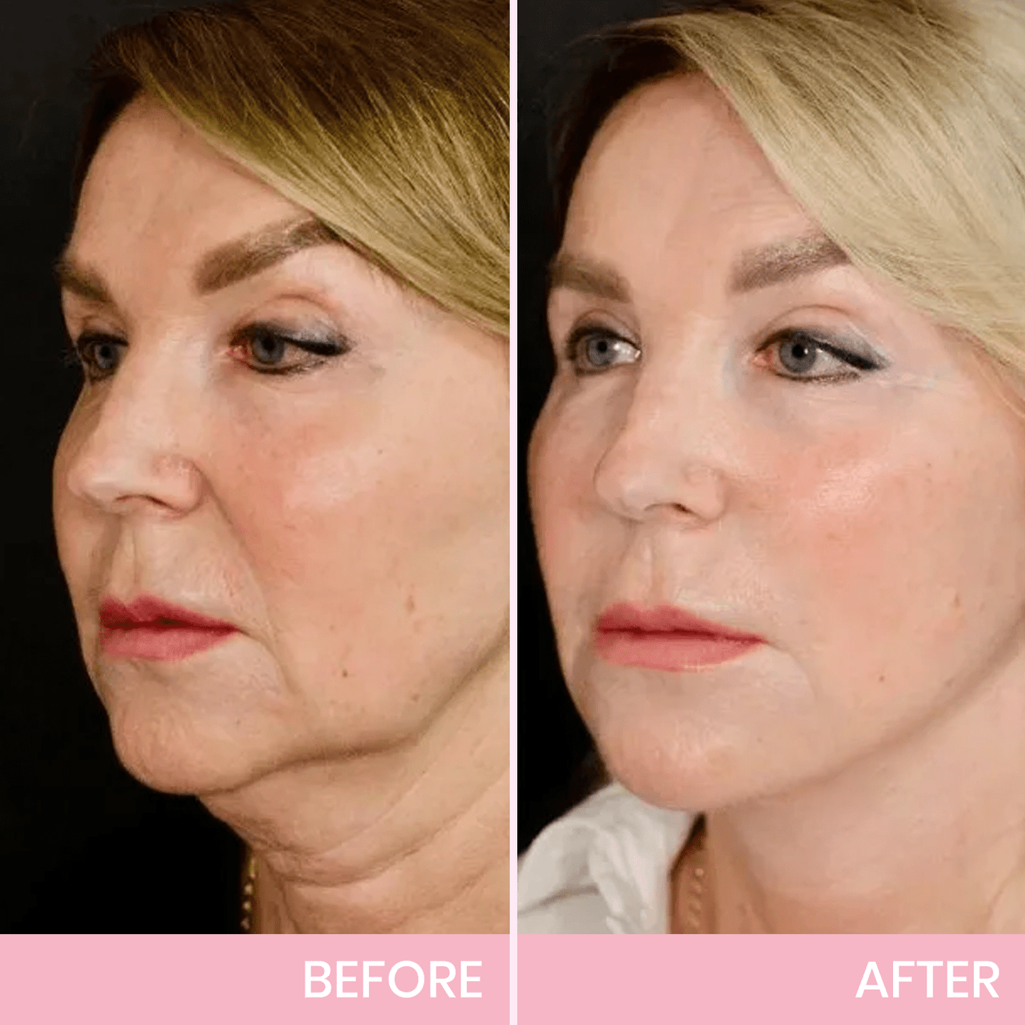 MOONDAR®❤V-Face Lifting Invisible Adhesive 01 Tape 10⚕️