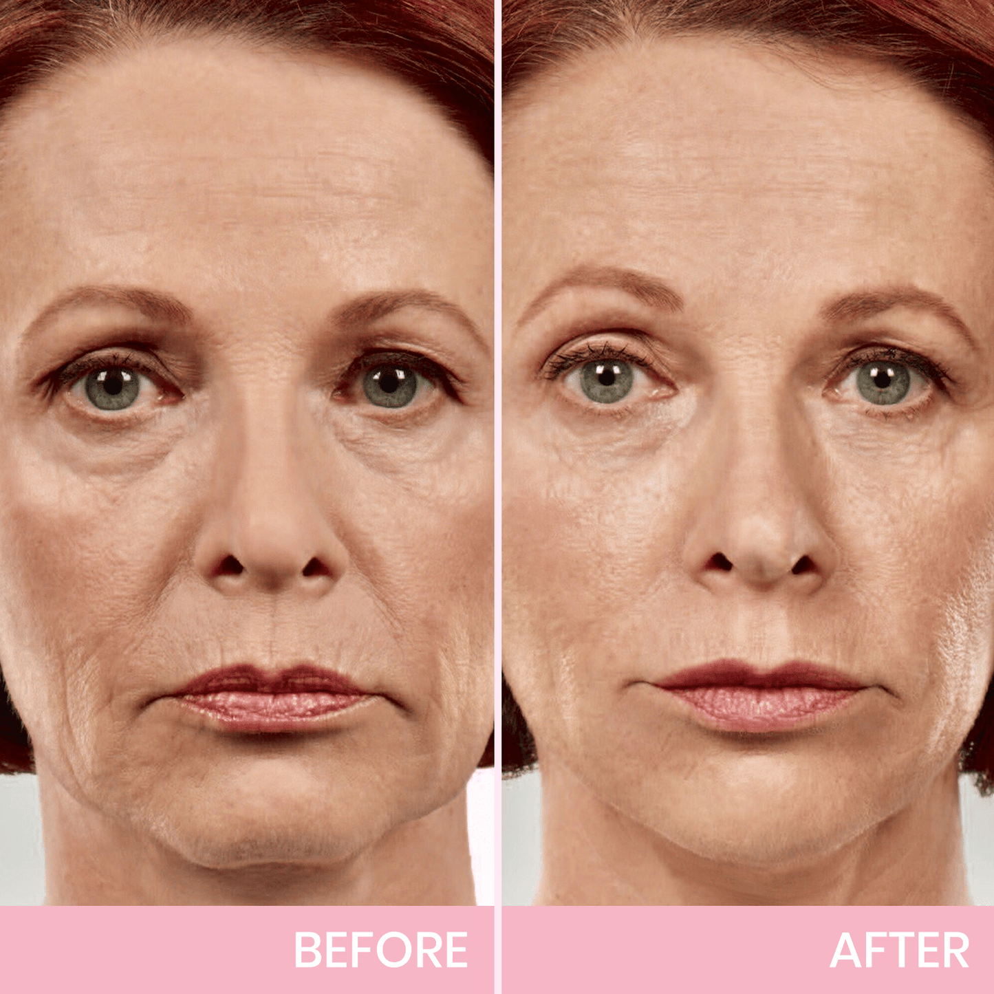 MOONDAR®❤V-Face Lifting Invisible Adhesive 01 Tape 10⚕️