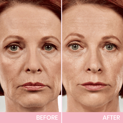 MOONDAR®❤V-Face Lifting Invisible Adhesive 01 Tape 10⚕️